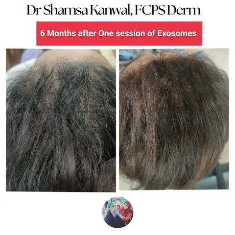 Dr Shamsa Kanwal, MBBS, FCPS Dermatology, MRCP1 UK (Best Dermatologist, Skin Specialist, Hair Exosomes, Botox, Fillers) in Rawalpindi, Islamabad Capital Territory
