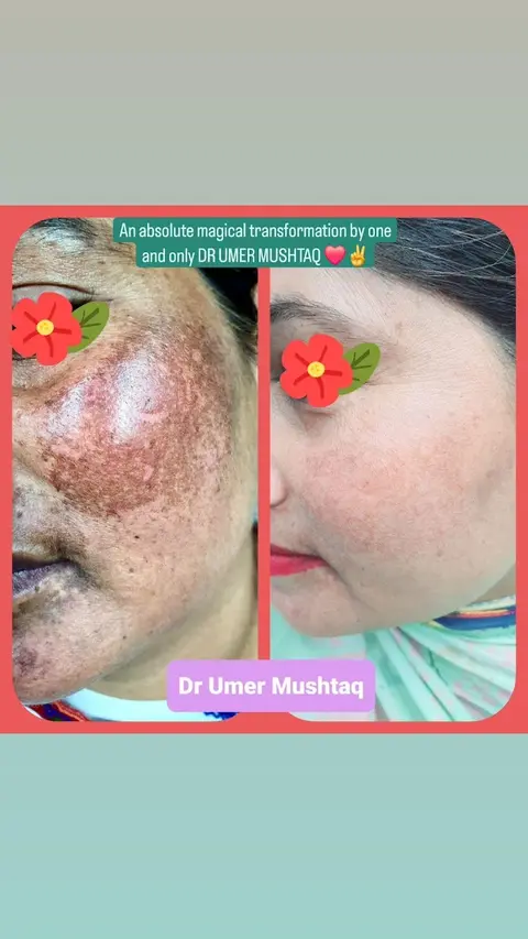 Dr Umer Mushtaq - BEST DERMATOLOGIST IN LAHORE in Lahore, Punjab