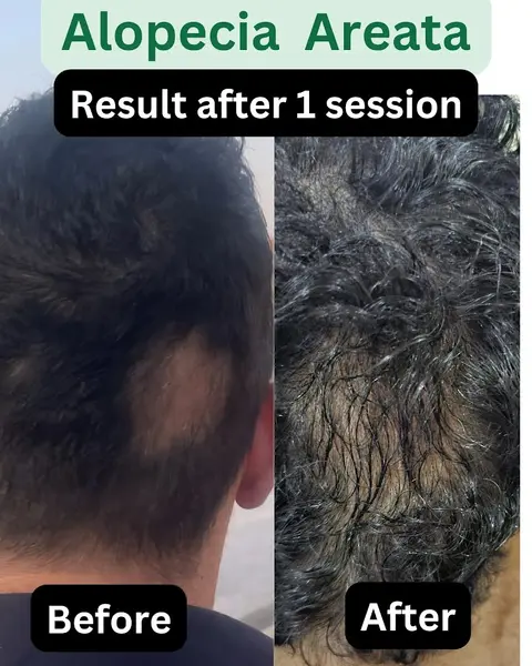 Dr Shamsa Kanwal, MBBS, FCPS Dermatology, MRCP1 UK (Best Dermatologist, Skin Specialist, Hair Exosomes, Botox, Fillers) in Rawalpindi, Islamabad Capital Territory