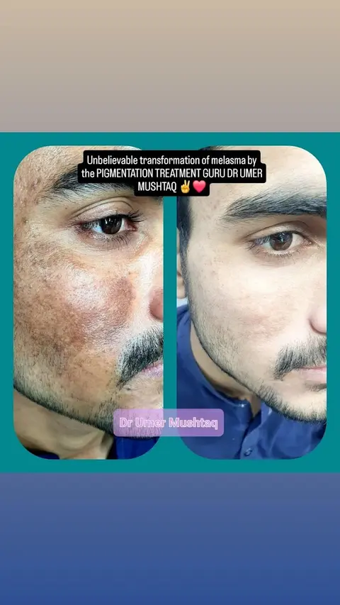Dr Umer Mushtaq - BEST DERMATOLOGIST IN LAHORE in Lahore, Punjab